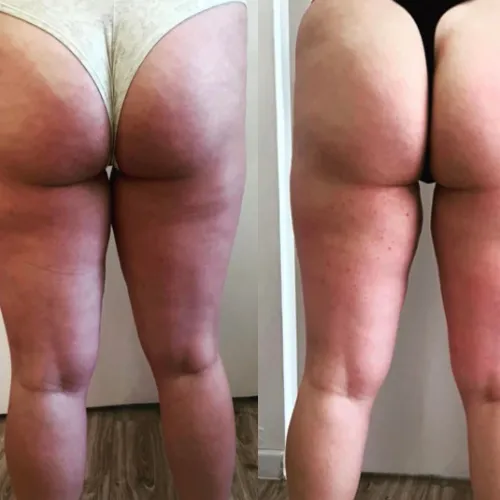 Înainte și după remodelare – diferență vizibilă în zona feselor și coapselor